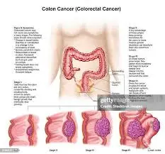 Understanding Colorectal Cancer: Symptoms, Treatment, and Importance
