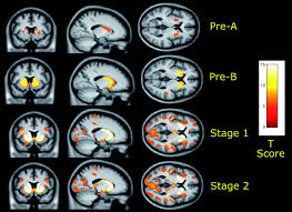 A Comprehensive Overview of Huntington’s Disease